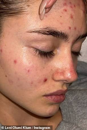 Дочь Хайди Клум, 19-летняя Лени, в понедельник зашла в свой Instagram, чтобы пролить свет на свою борьбу с прыщами, поделившись откровенным селфи без макияжа со своими 1,9 миллионами подписчиков в Instagram.